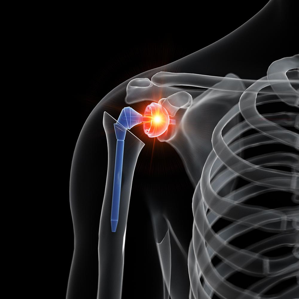 Read more about the article Shoulder Replacement Rehabilitation